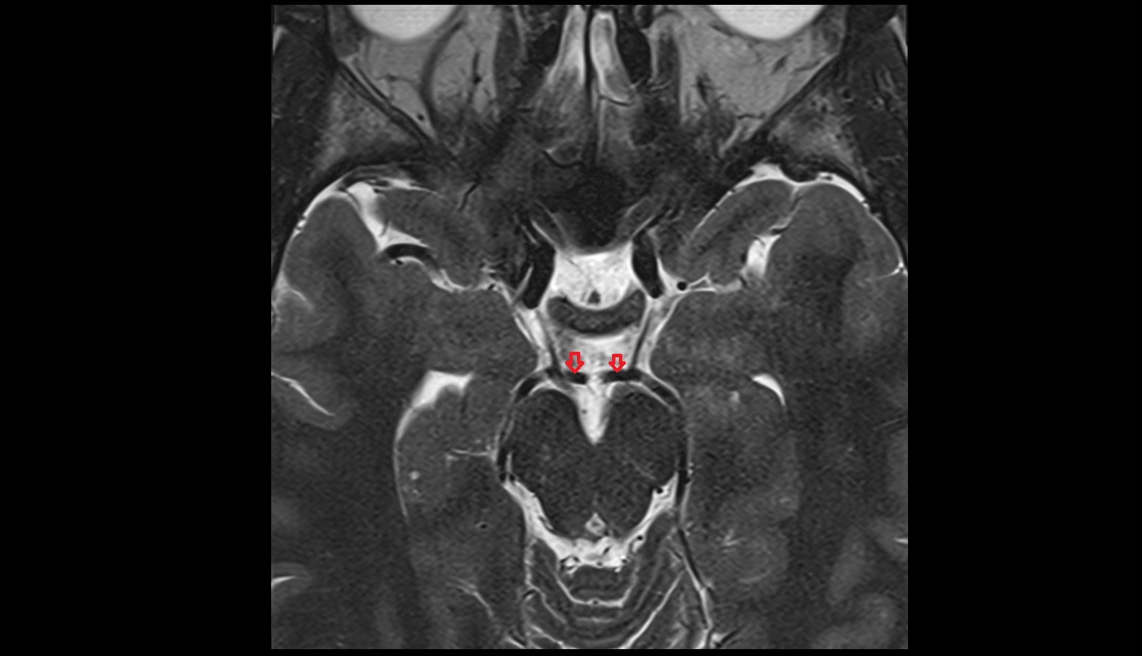 Posterior Cerebral Artery (P1 Segment