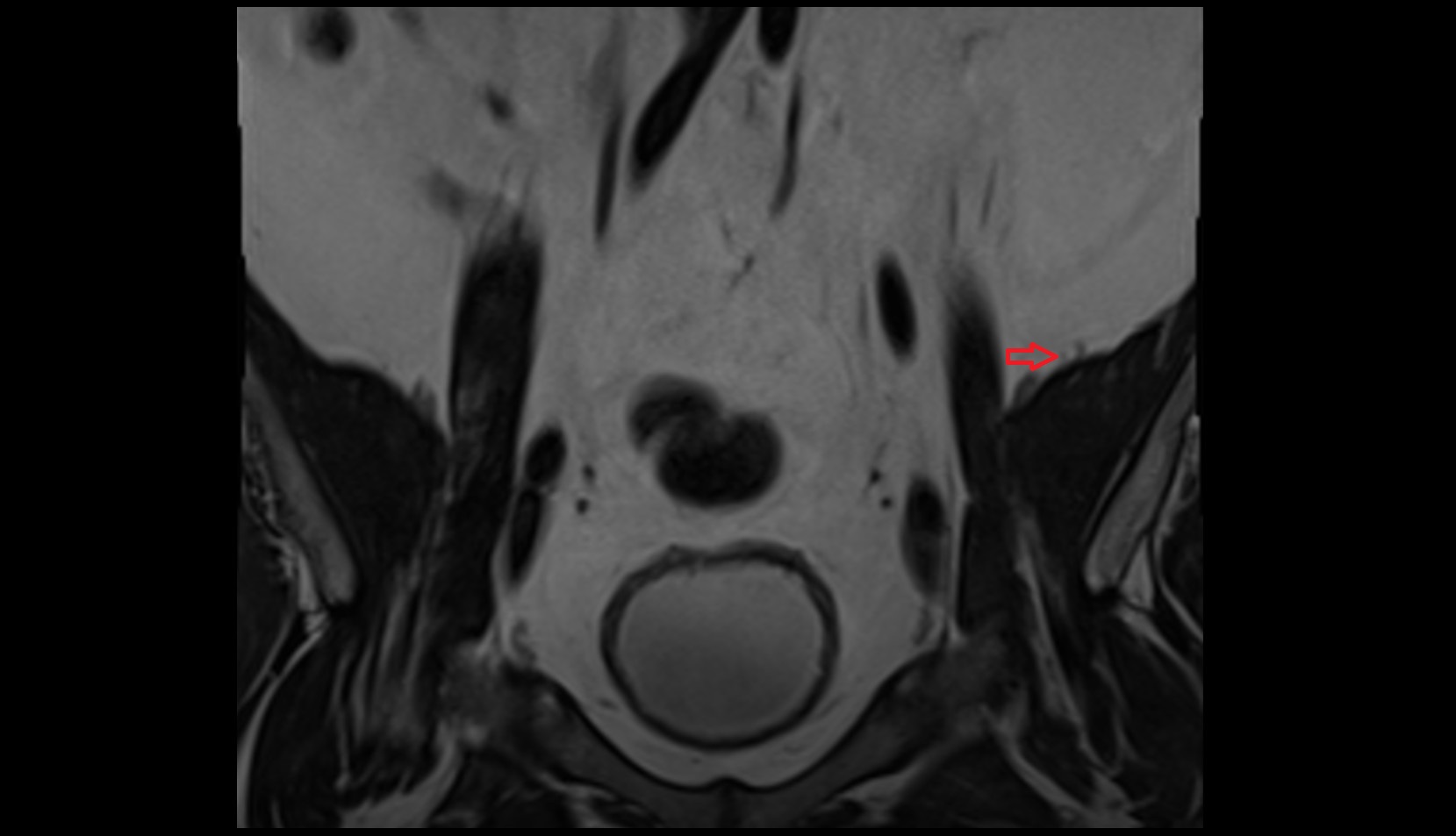 Posterior Lateral Femoral Cutaneous Nerve MRI coronal image