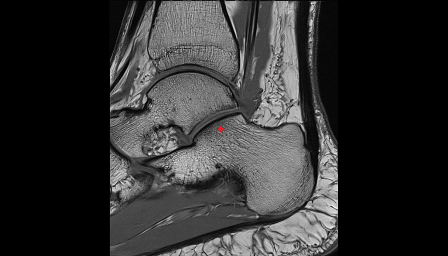 Posterior Talar Articular Facet of the Calcaneus agittal MRI cross sectional anatomy 3T MRI AI enhanced radiology image-img-00000-00000