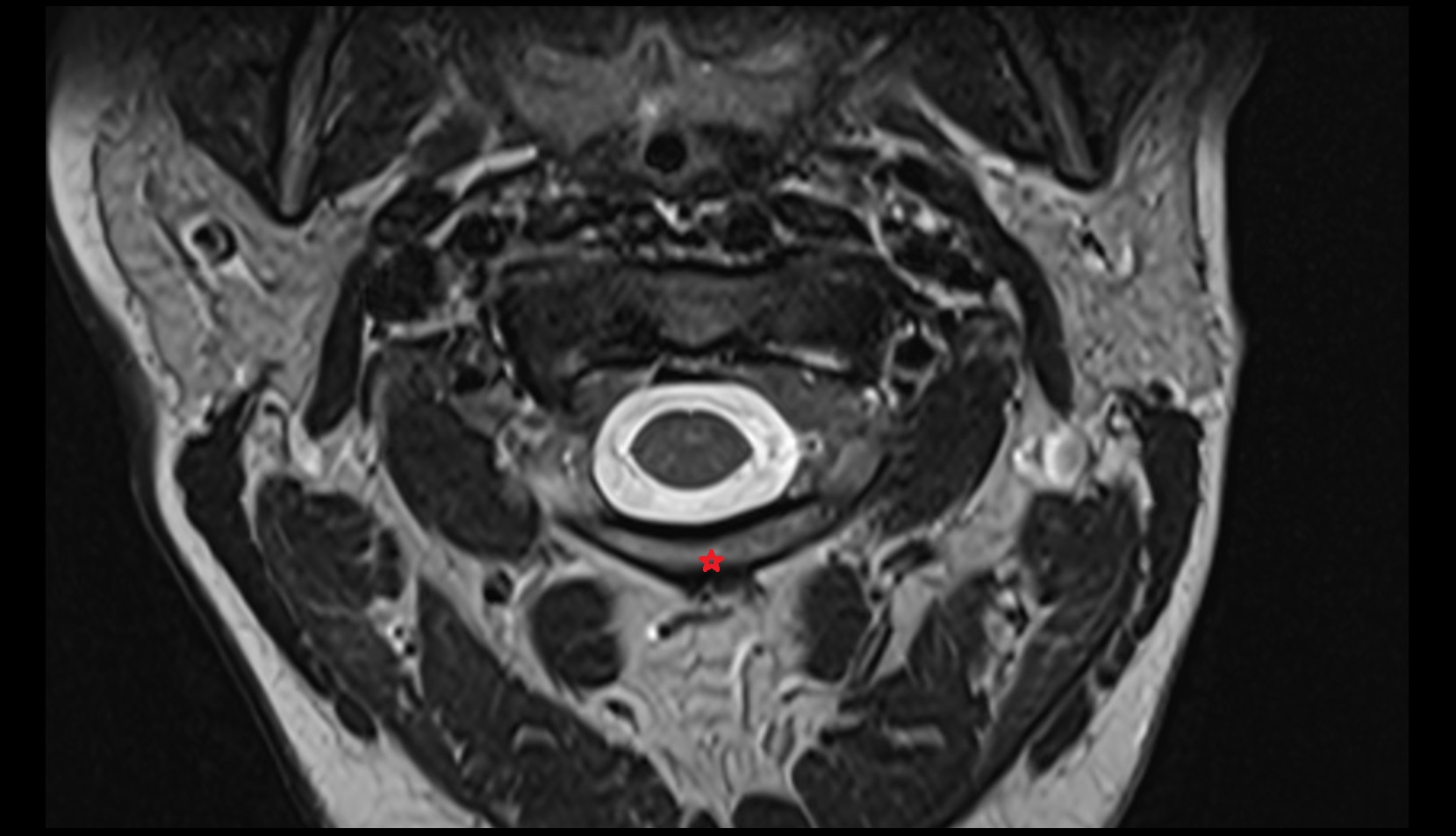 Posterior arch of atlas axial mri