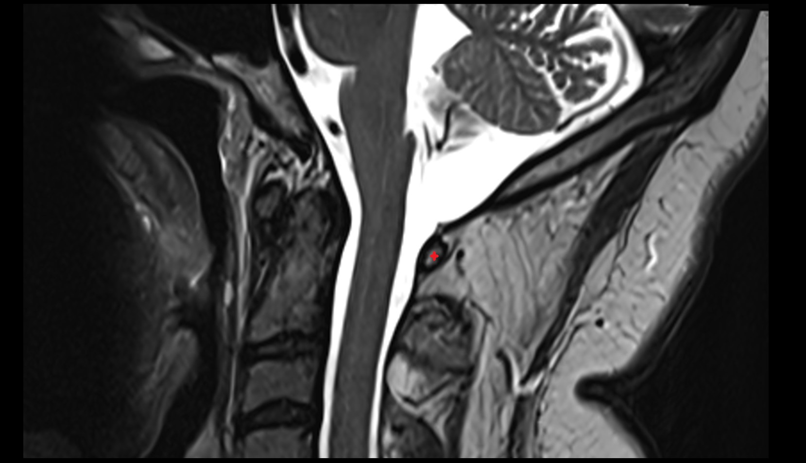 Posterior arch of atlas sag mri