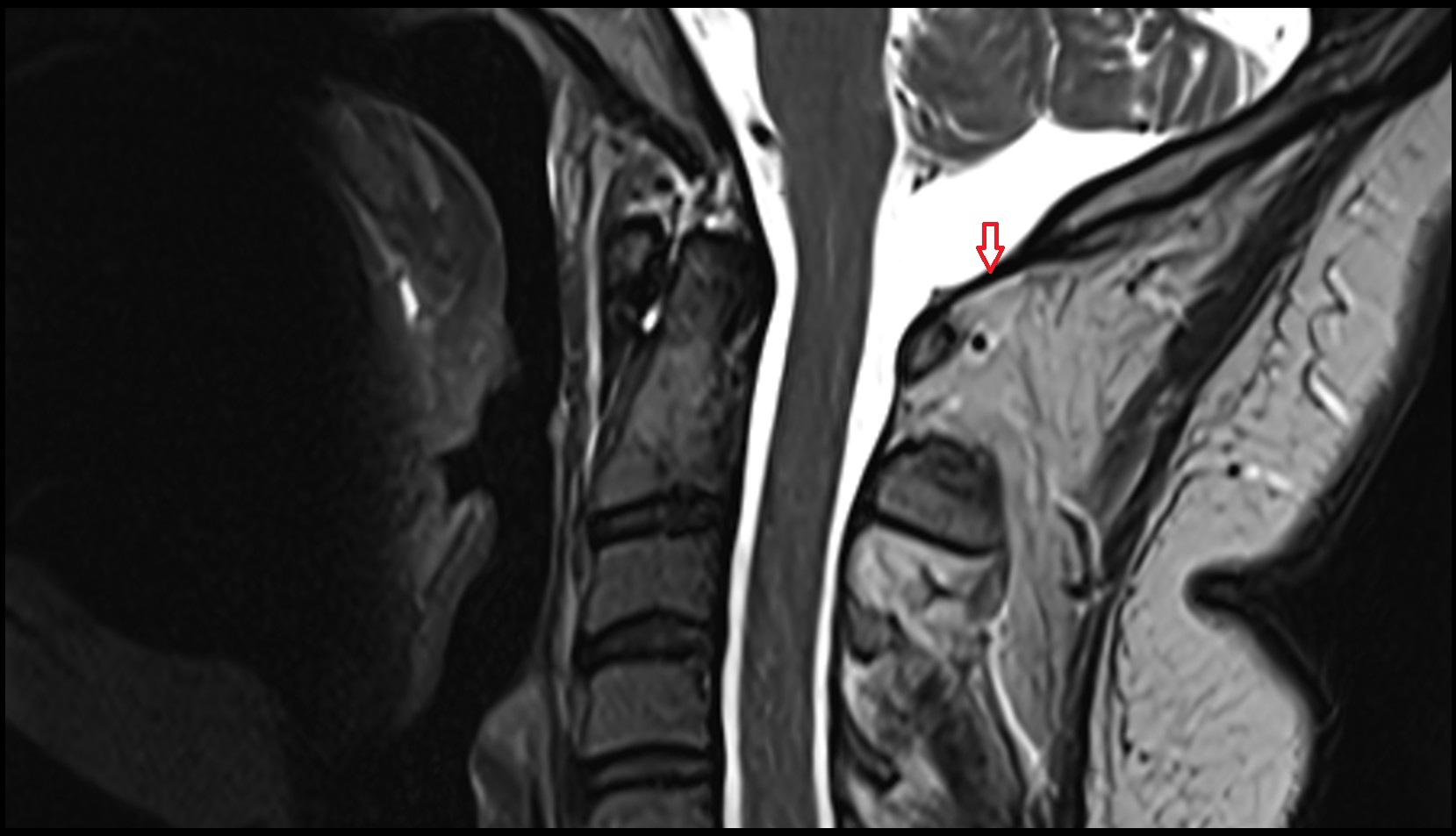 Posterior atlantooccipital membrane mri sagittal image