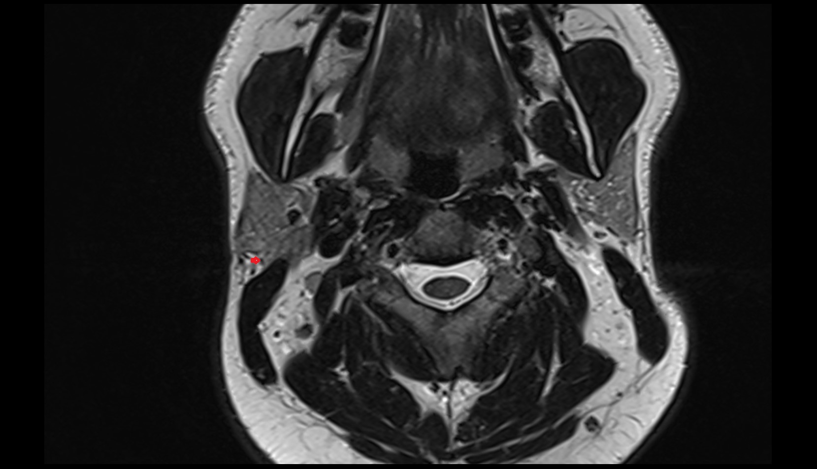 Posterior auricular artery mri axial image