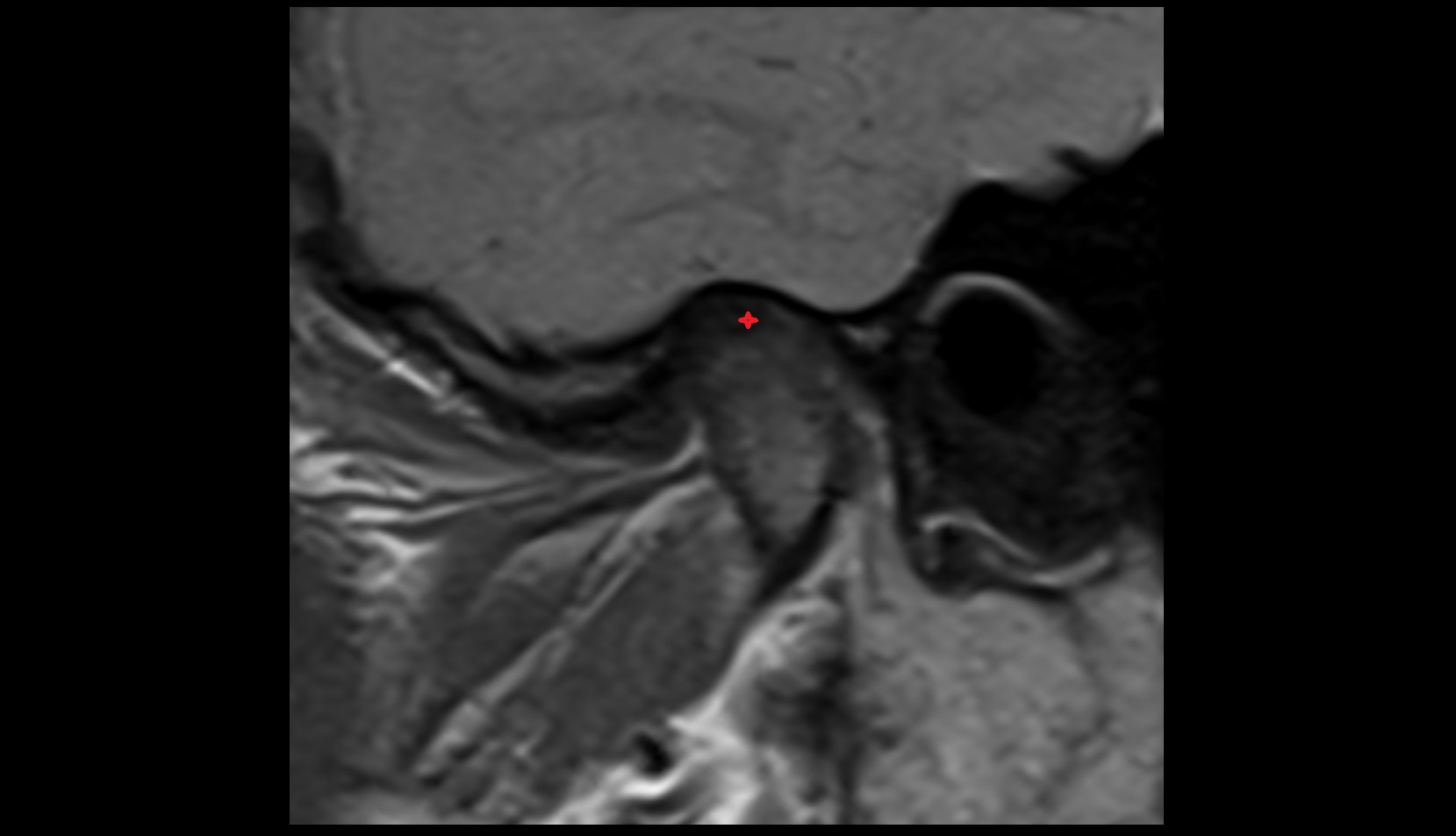 Posterior band of articular disc