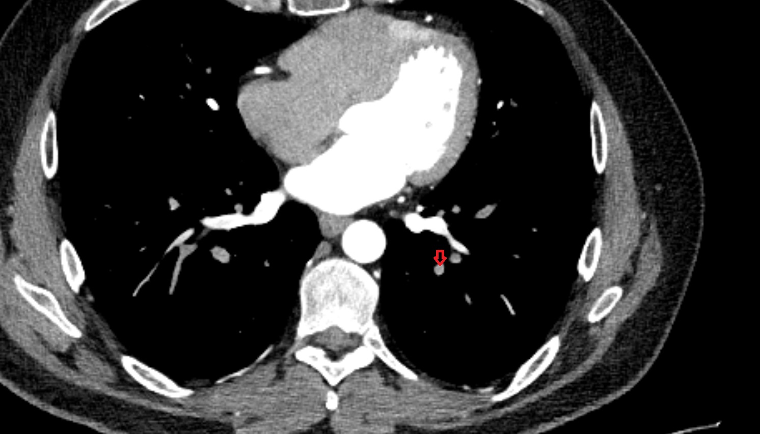 Posterior basal segmental artery of left lung  anatomy CT axial  image -img-00000-00000