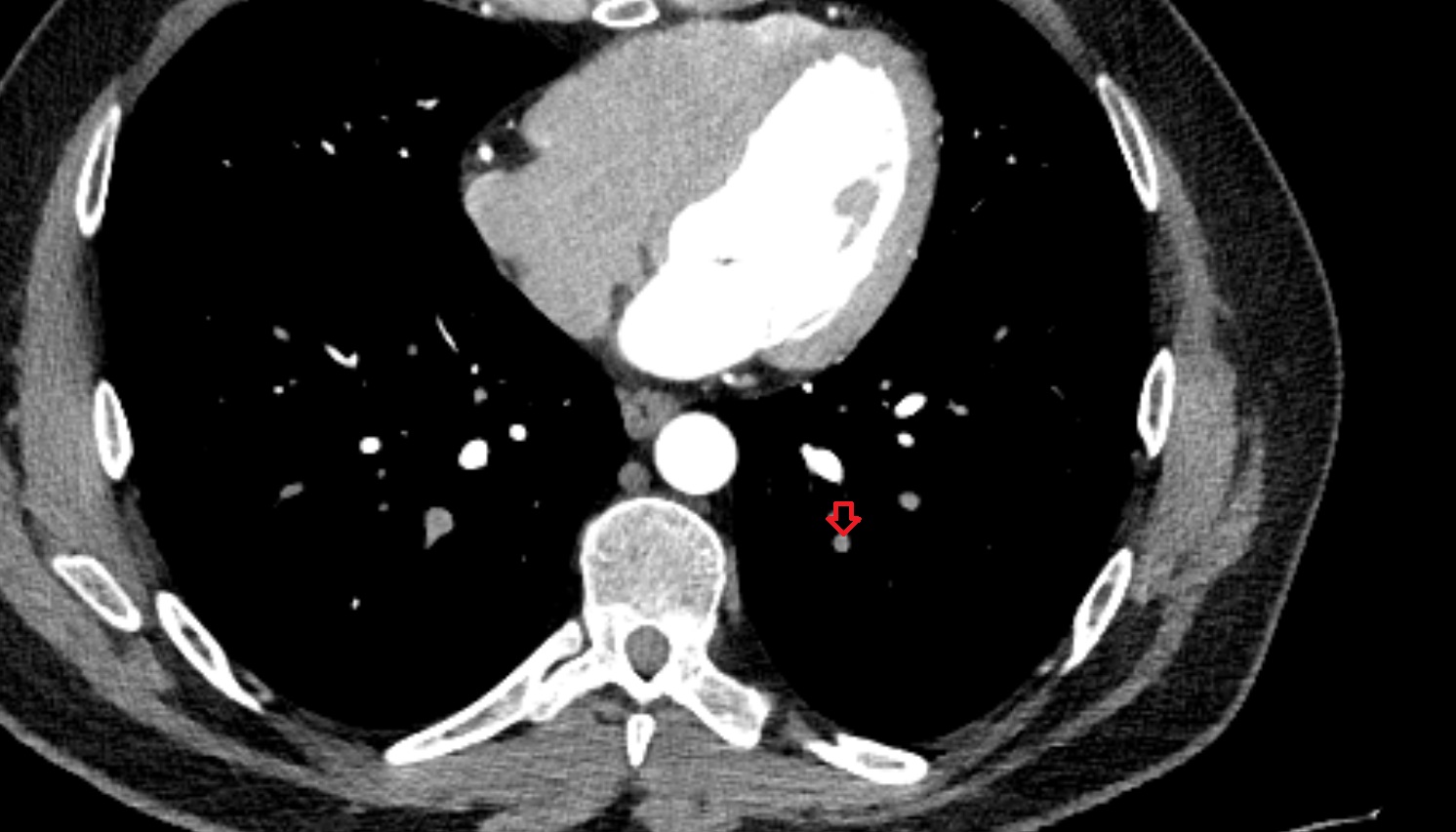 Posterior basal segmental artery of left lung  anatomy CT axial  image -img-00000-00000_00001
