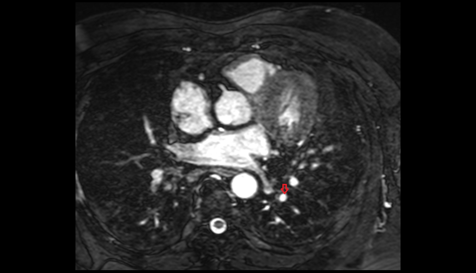 Posterior basal segmental artery of left lung mri image