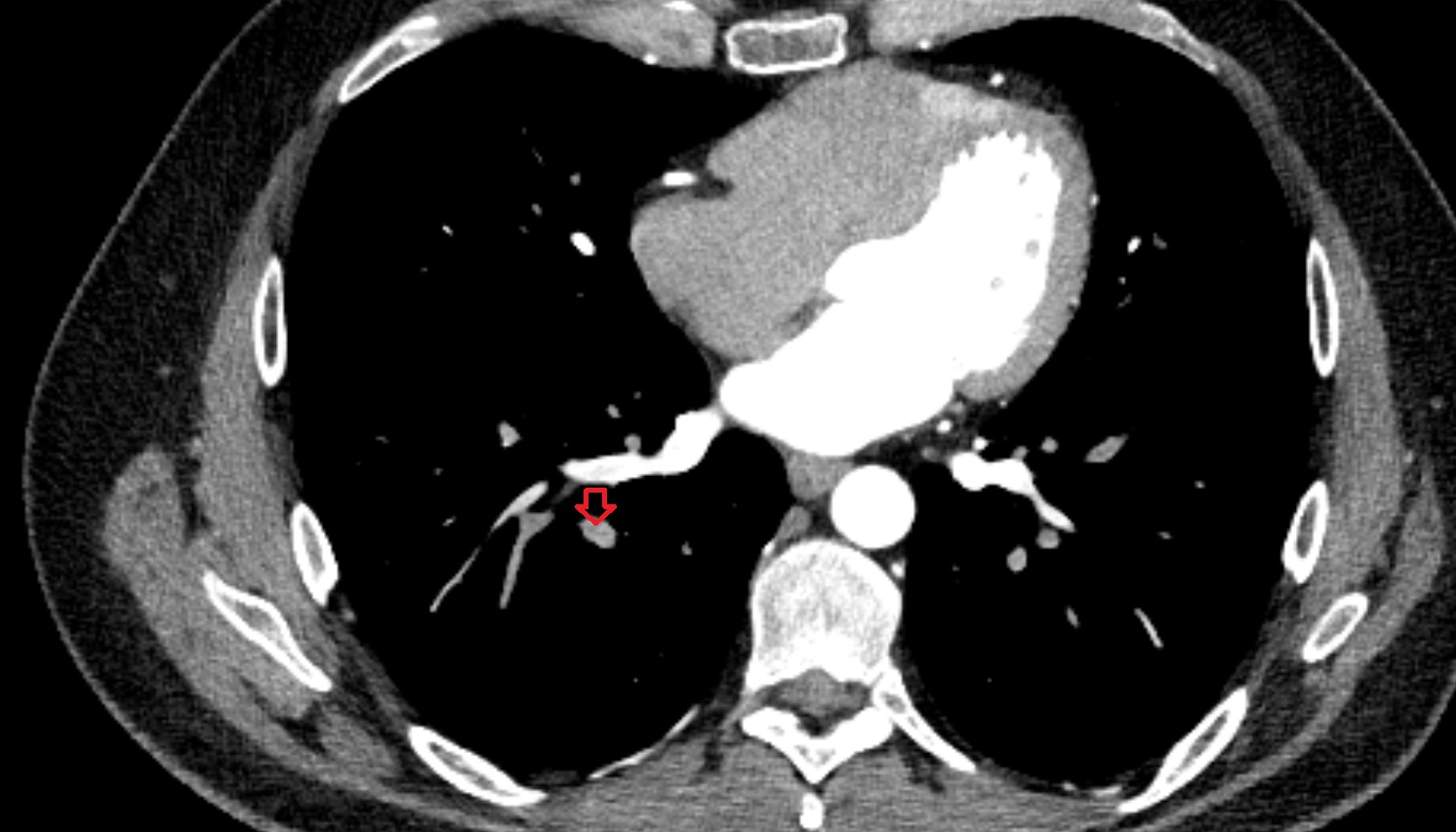Posterior basal segmental artery of right lung  anatomy CT axial  image -img-00000-00000_00001