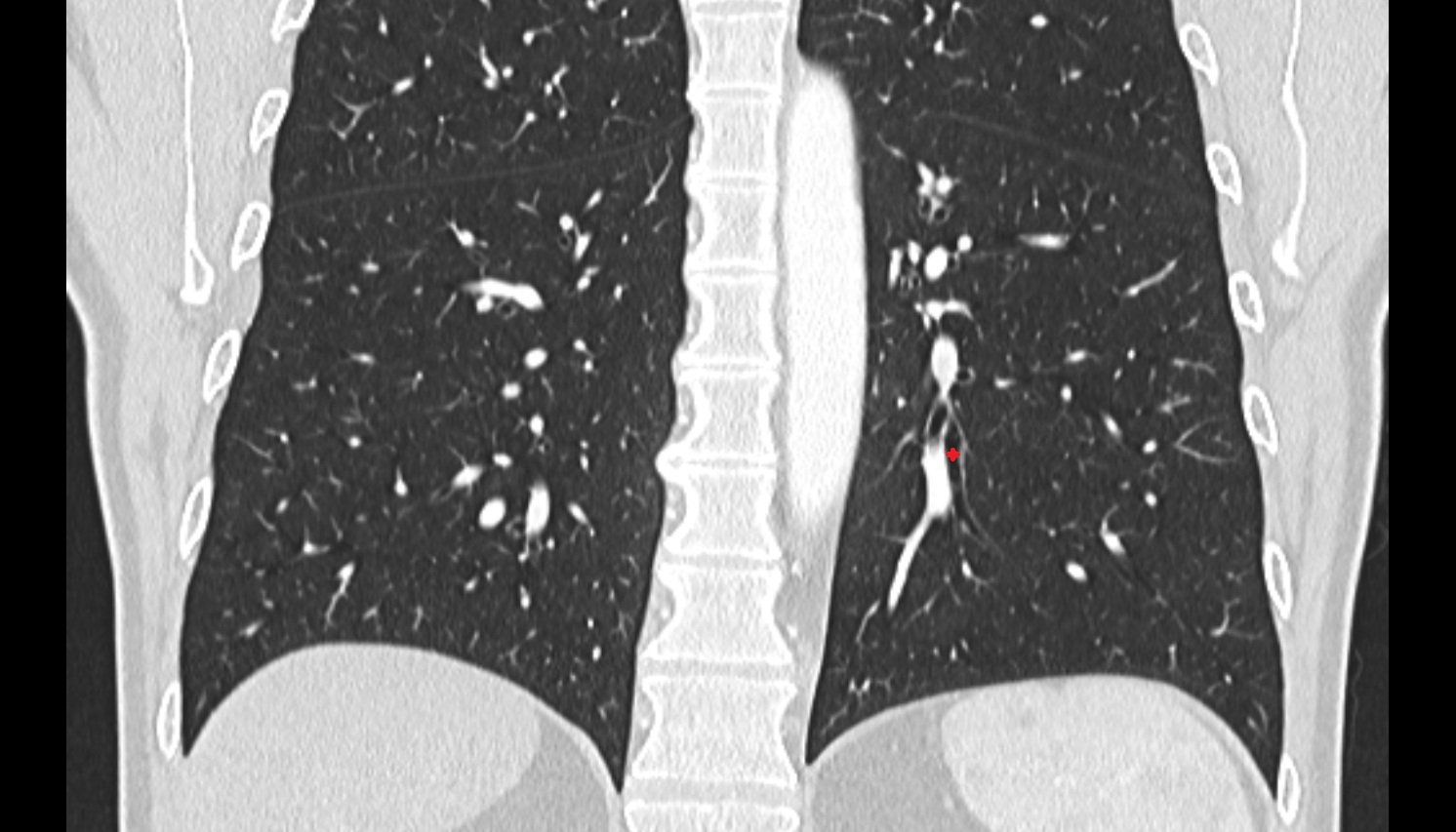 Posterior basal segmental bronchus of left lung (B10)  anatomy  CT coronal  image -img-00000-00000