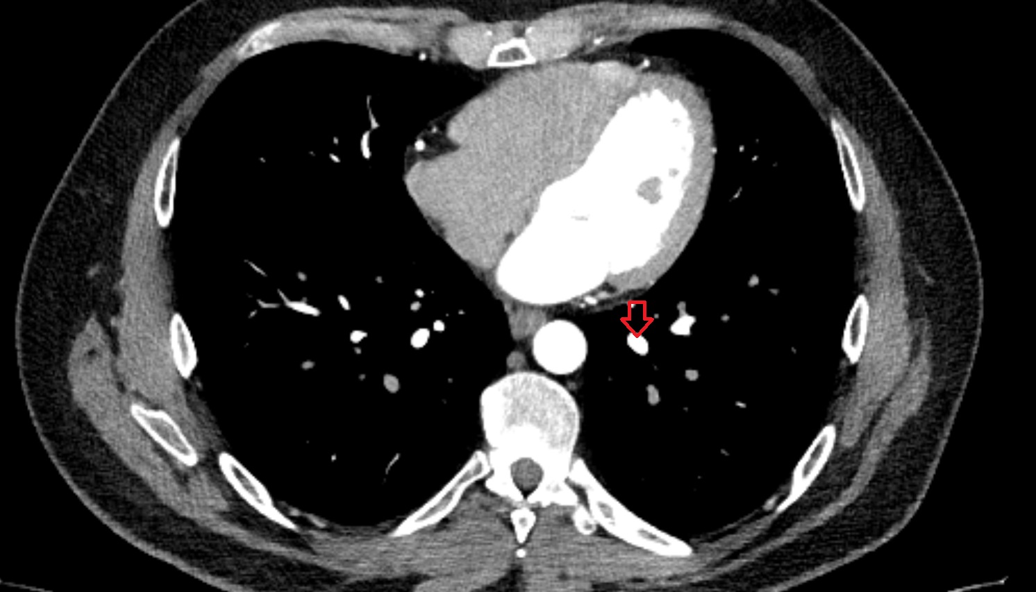 Posterior basal vein of left lung  anatomy CT axial  image -img-00000-00000
