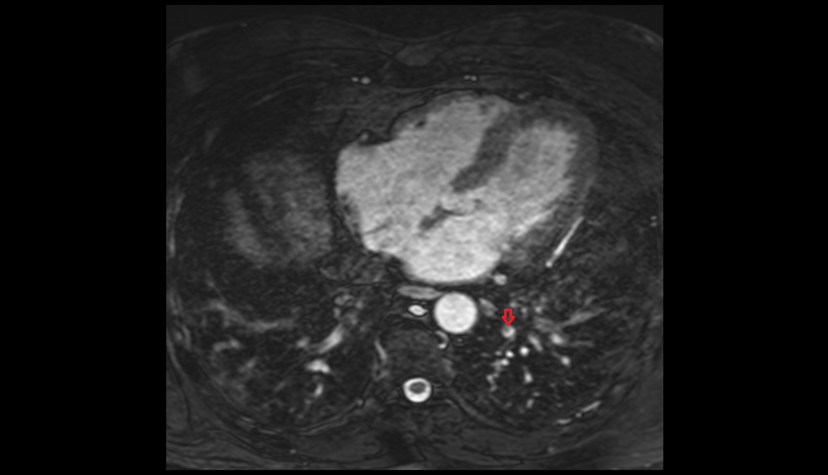 Posterior basal vein of left lung mri axial image