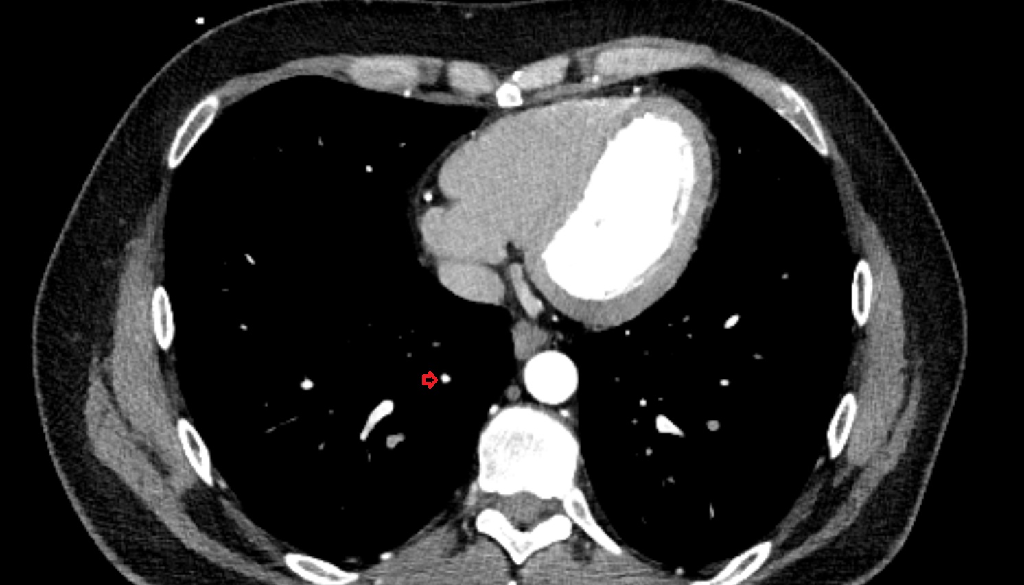 Posterior basal vein of right lung anatomy CT axial  image -img-00000-00000