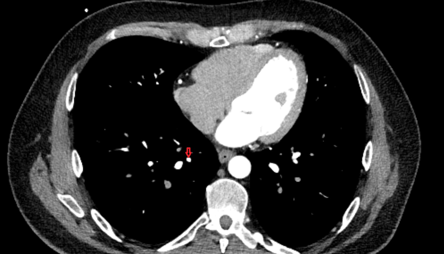 Posterior basal vein of right lung anatomy CT axial  image -img-00000-00000_00001