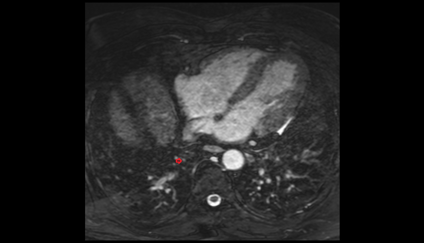 Posterior basal vein of right lung mri anatomy