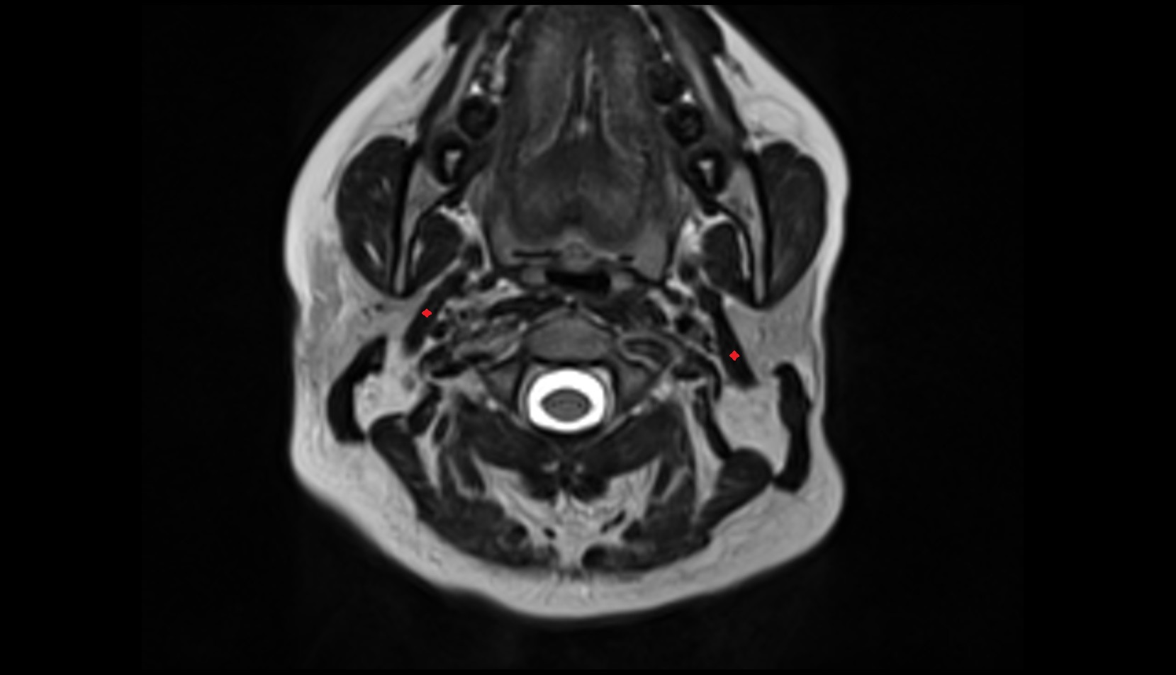 Posterior belly of digastric muscleMRI axial image
