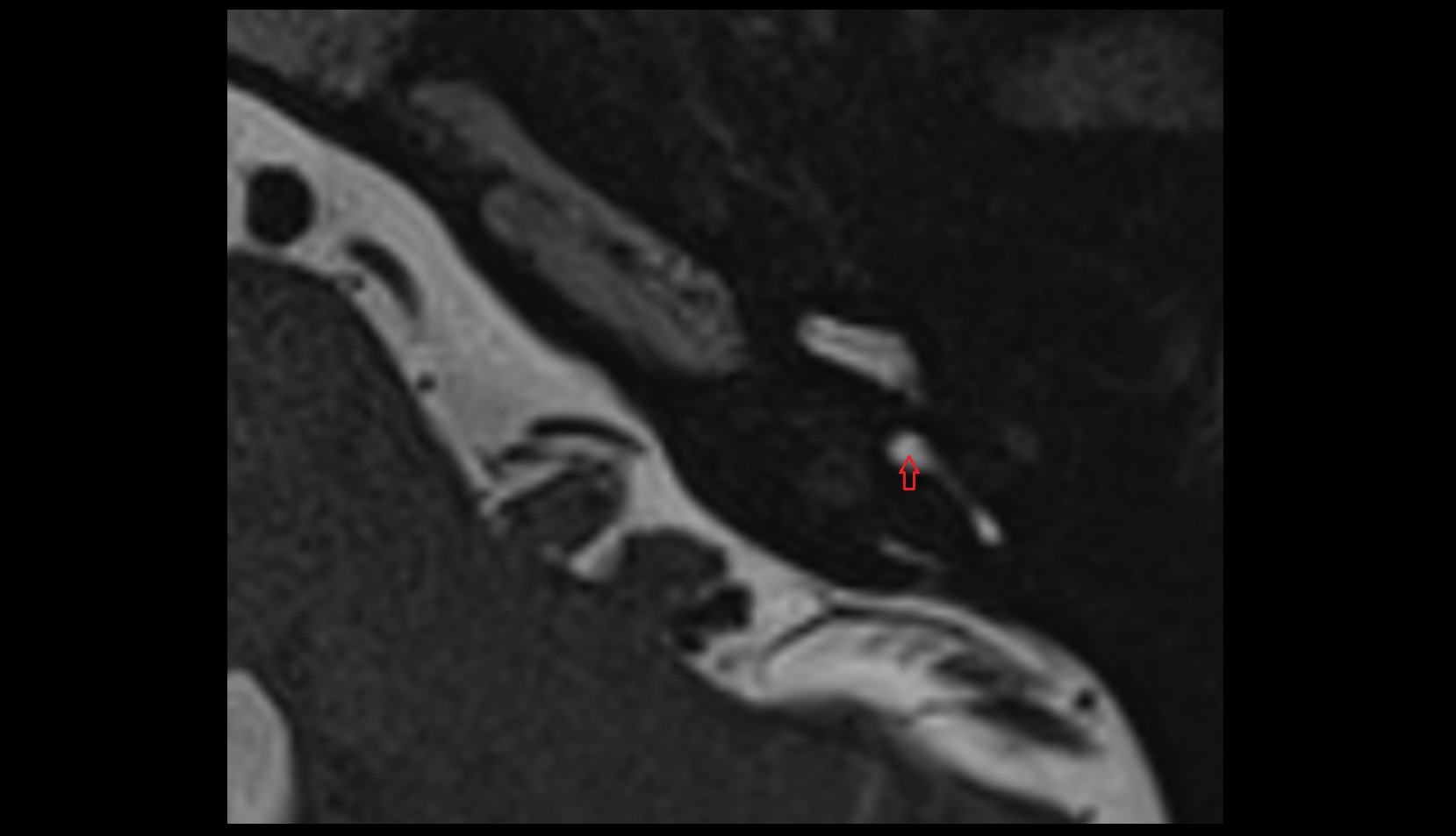 Posterior bony ampulla MRI axial image