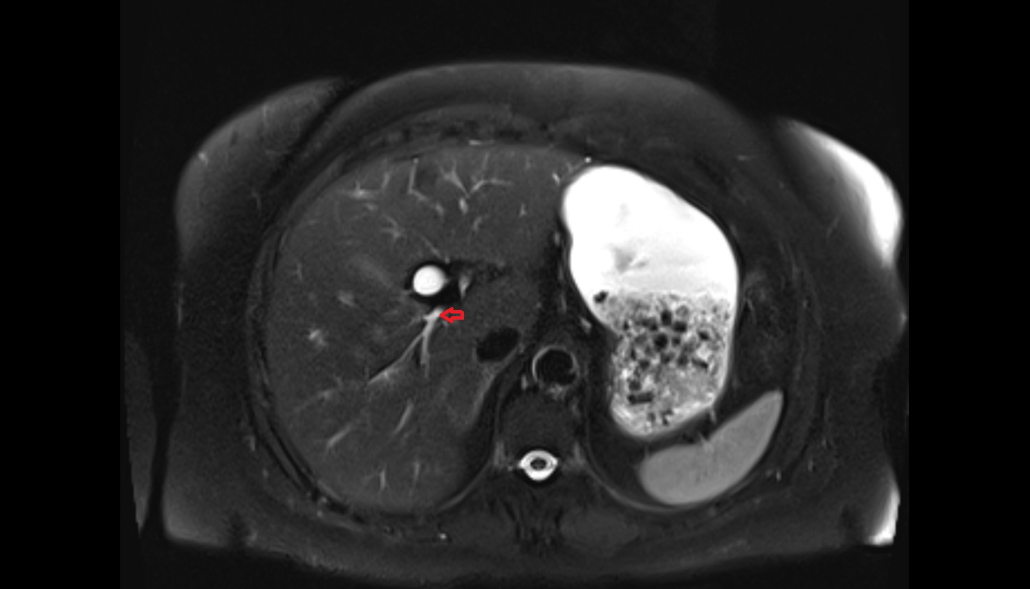 Posterior branch of right hepatic duct  mri  coronal  anatomy  image-img-00000-00000