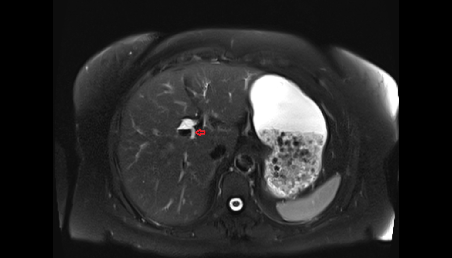 Posterior branch of right hepatic duct  mri  coronal  anatomy  image-img-00000-00000_00001