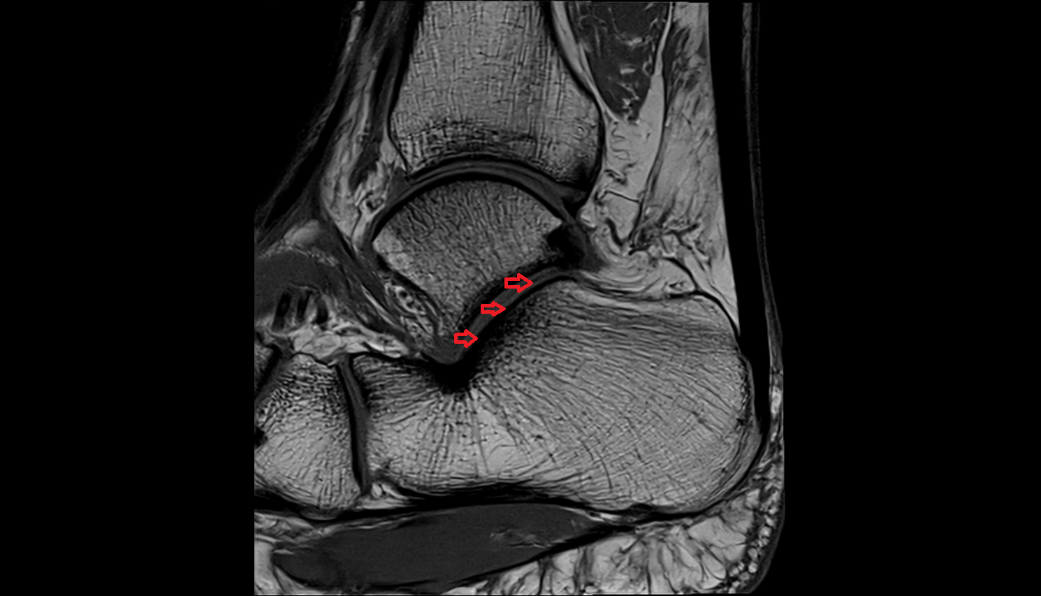 Posterior calcaneal articular facet  mri  anatomy labelled image-img-00000-00000