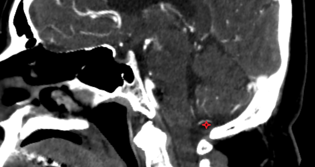 Posterior cerebellomedullary cistern (cisterna magna)  CT sag anatomy image