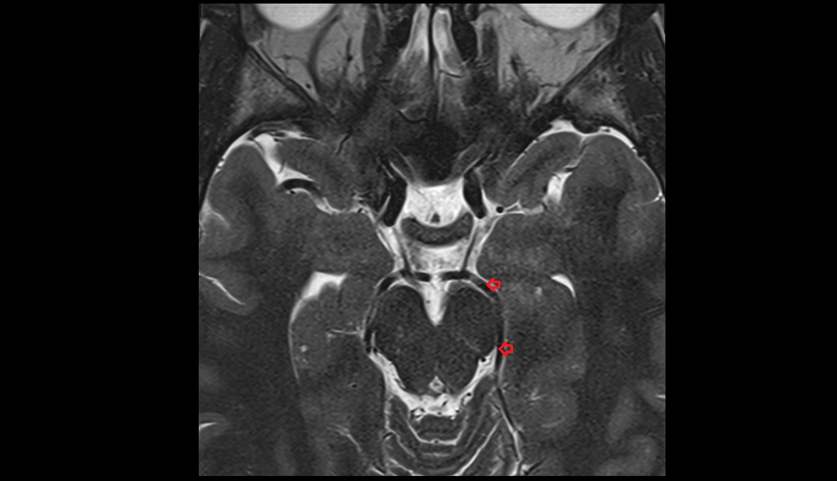 Posterior cerebral artery (P2 Segment)