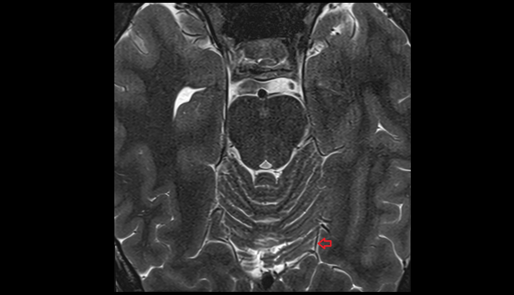 Posterior cerebral artery (P4 Segment)