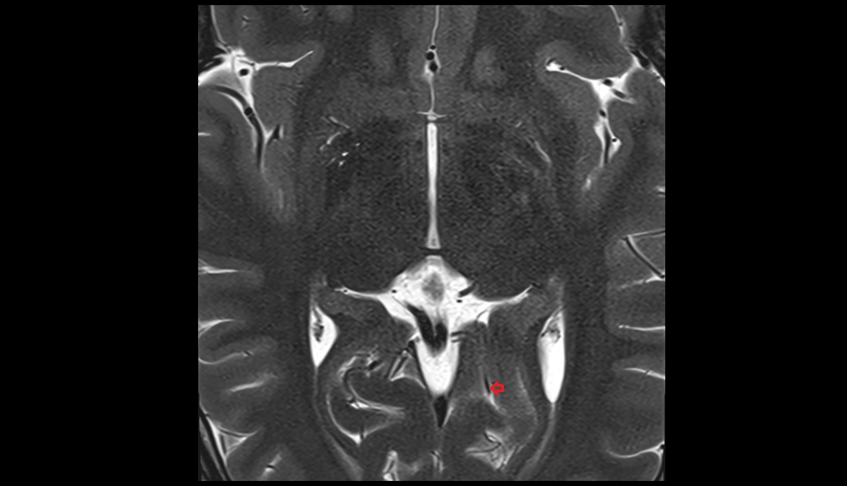 Posterior cerebral artery (P4 Segment) 1