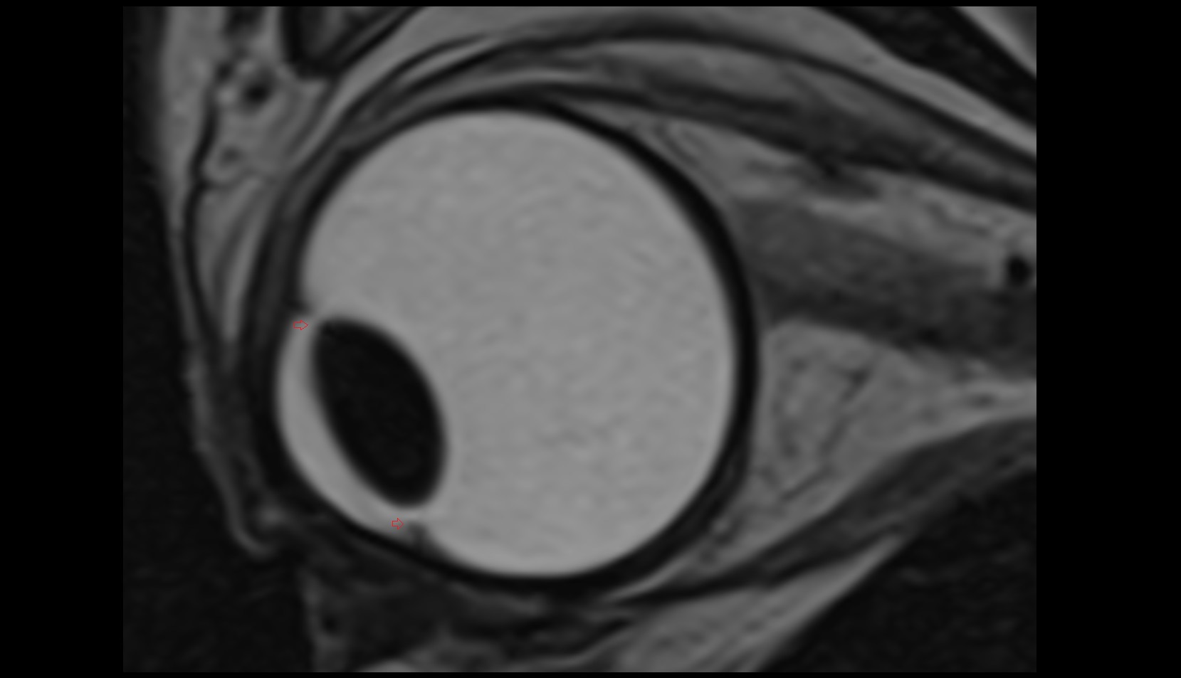Posterior chamber of eyeball mri image