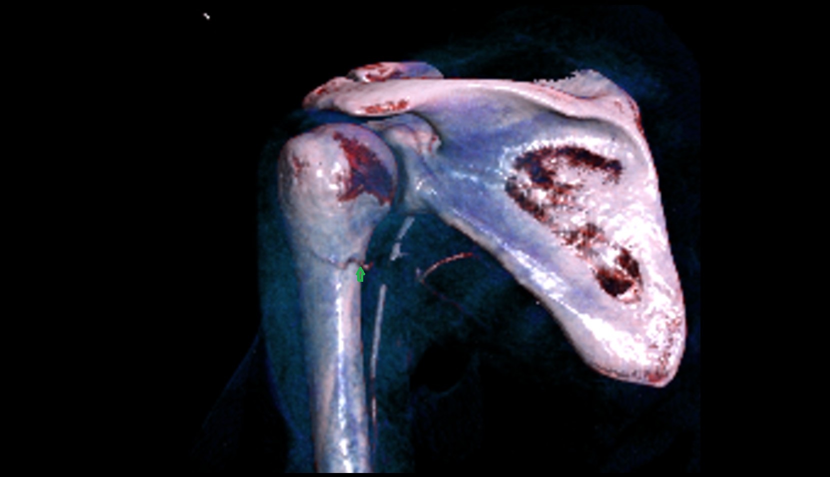 Posterior circumflex humeral artery 3d vrt image