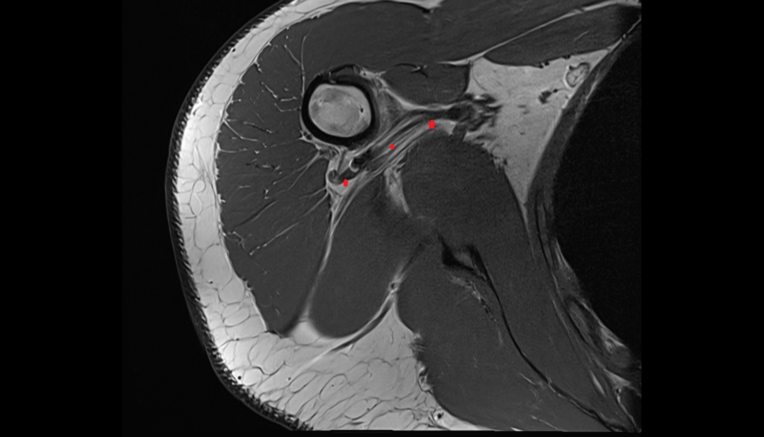 Posterior circumflex humeral artery  axial cross sectional anatomy 3T MRI AI enhanced radiology image-img-00000-00000