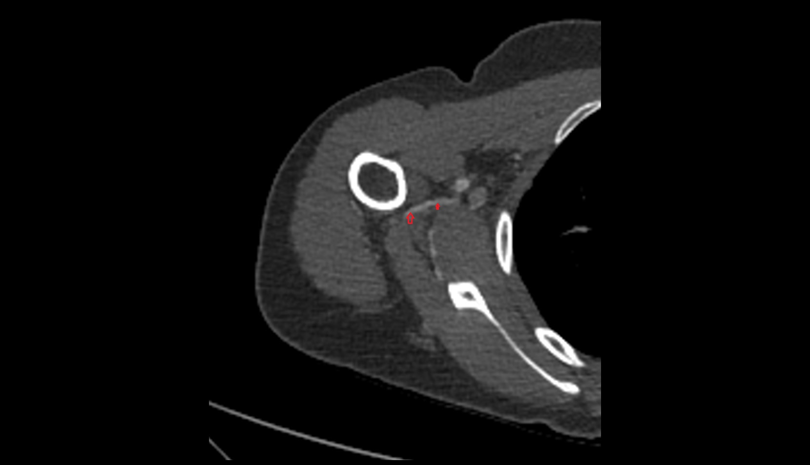 Posterior circumflex humeral artery ct axial