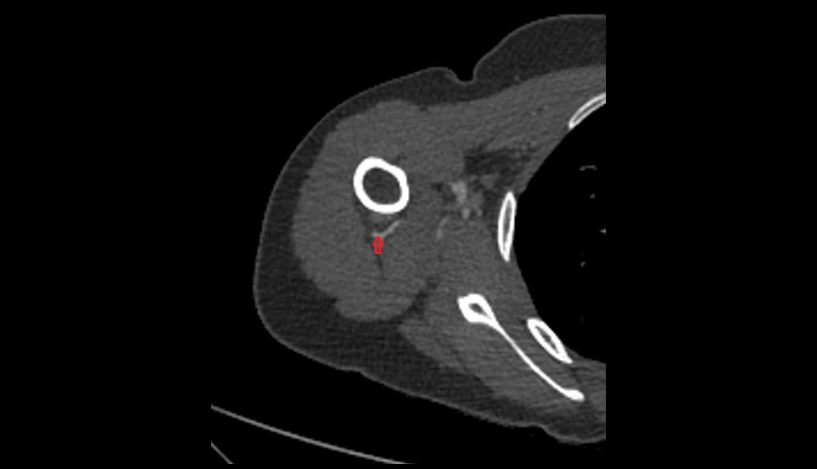 Posterior circumflex humeral artery ct axial  1