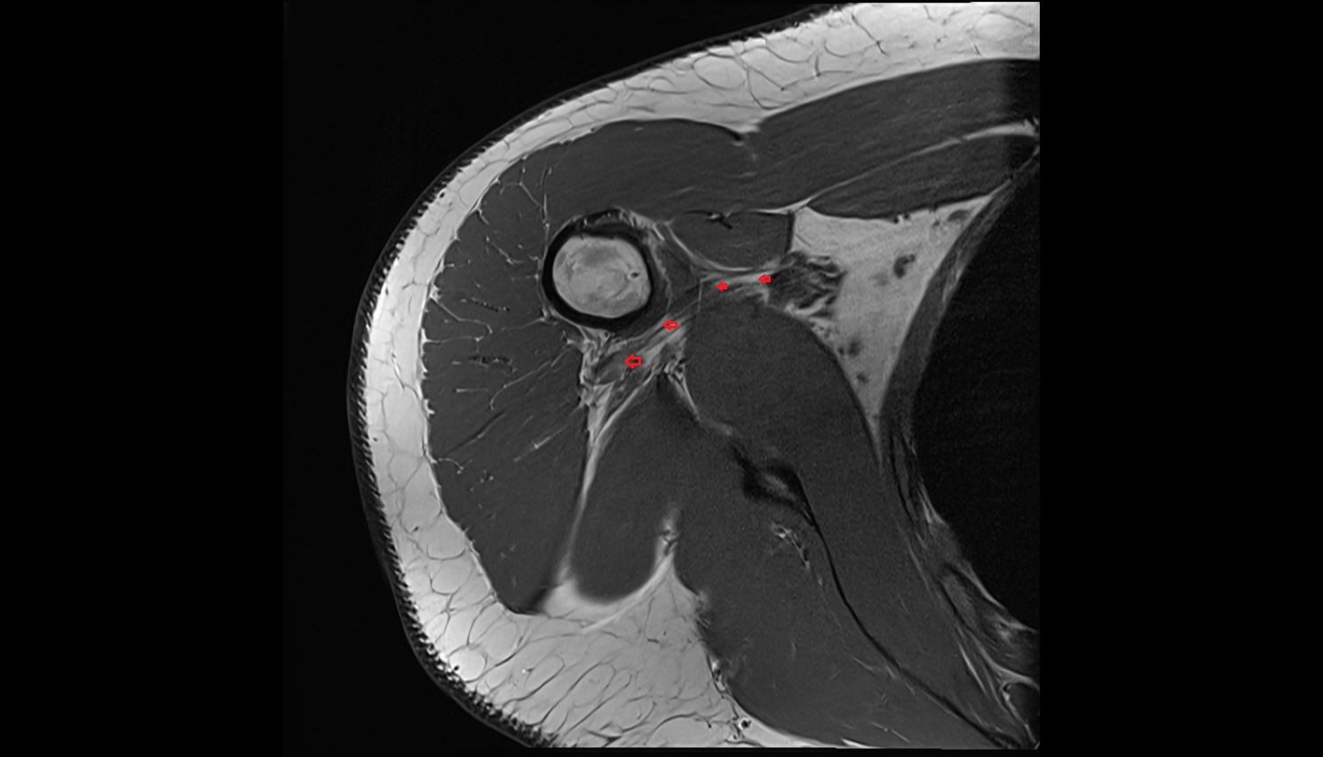 Posterior circumflex humeral vein axial cross sectional anatomy 3T MRI AI enhanced radiology image-img-00000-00000