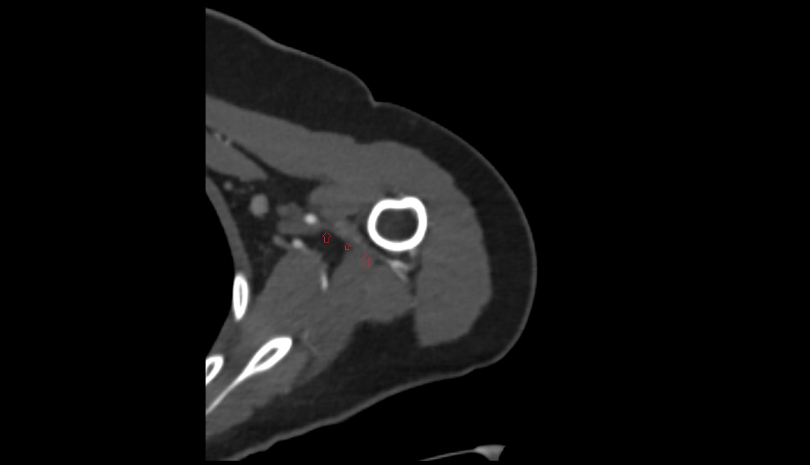 Posterior circumflex humeral vein ct axial image