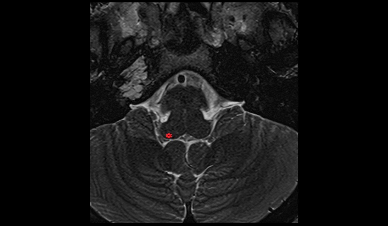 Posterior cochlear nucleus MRI 3T image