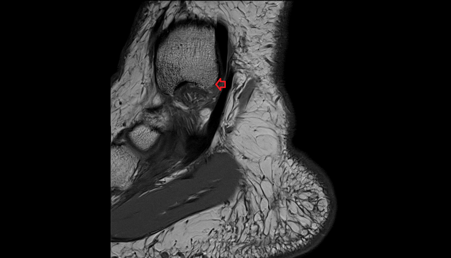 Posterior colliculus of medial malleolus  mri  anatomy labelled image-img-00000-00000
