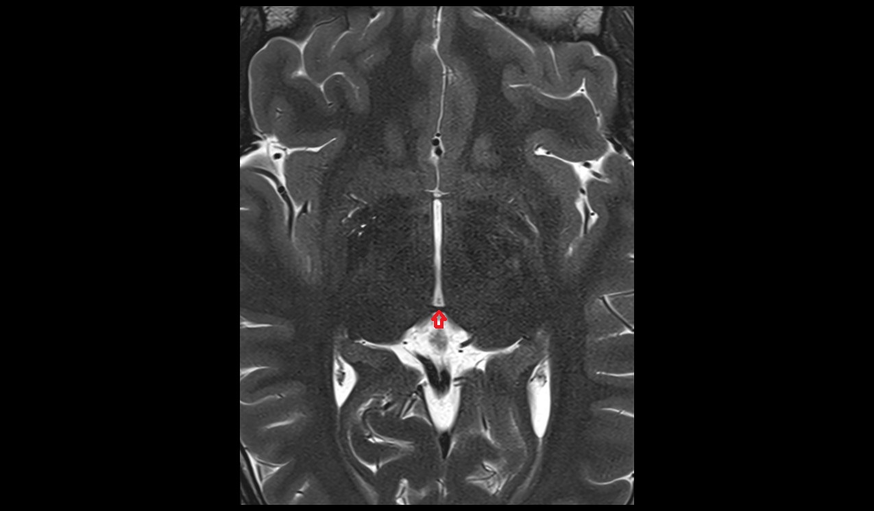 Posterior commissure mri 3t axial image