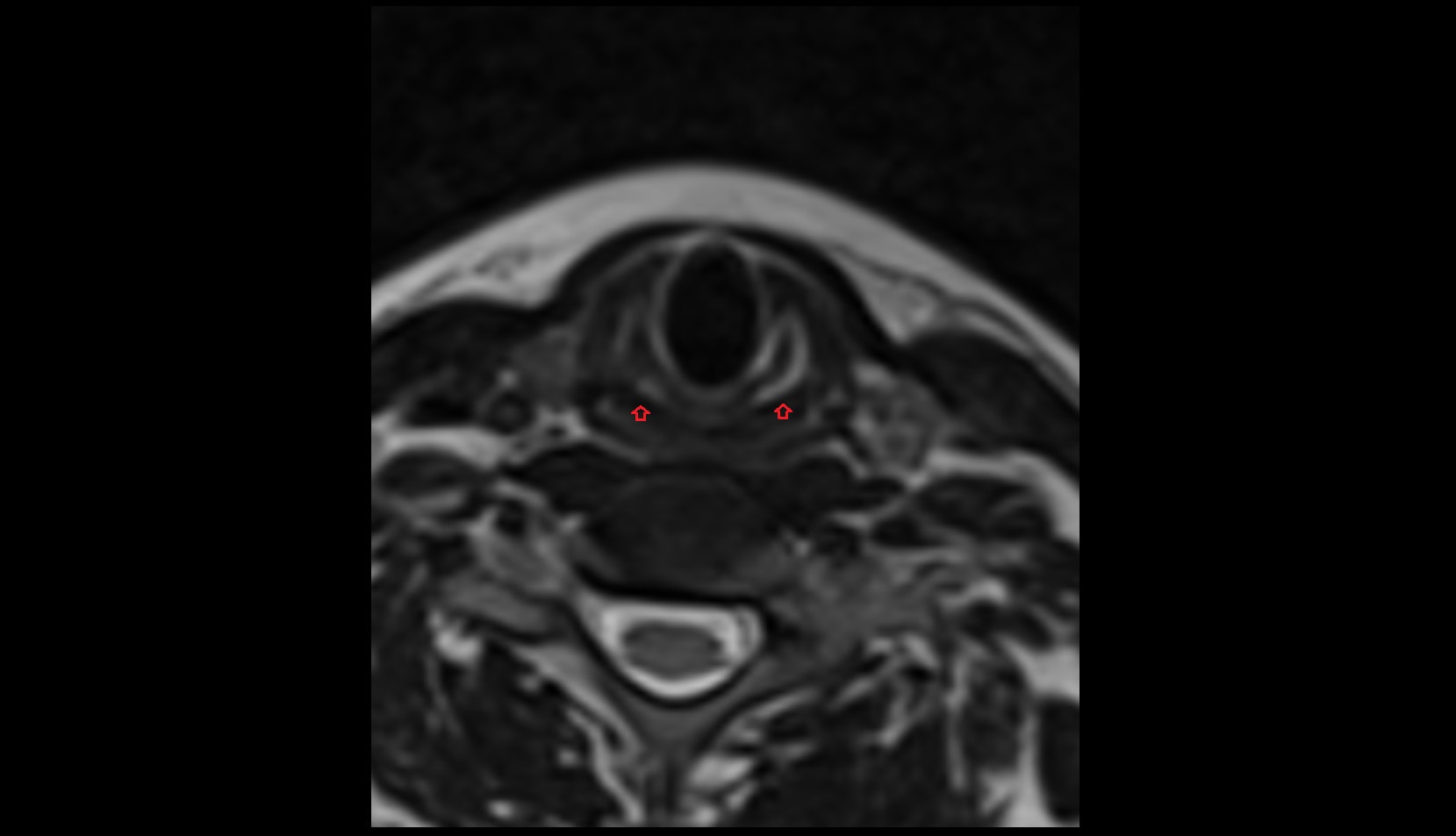 Posterior cricoarytenoid muscle MRI AXIAL IMAGE