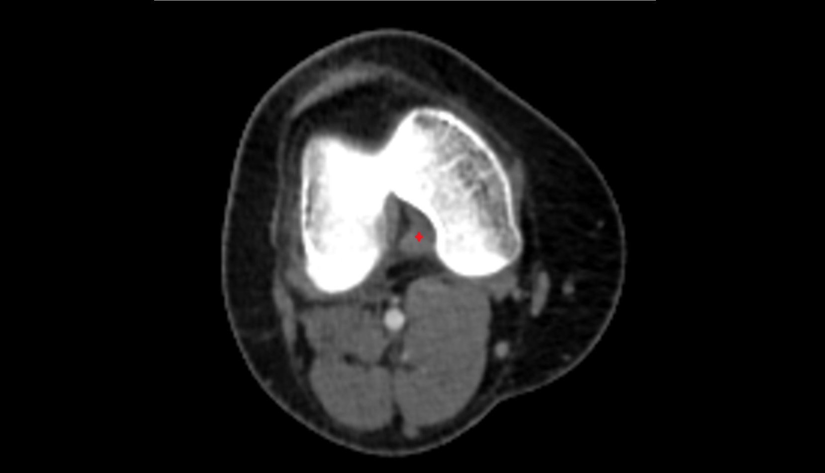Posterior cruciate ligament (PCL) axial ct image