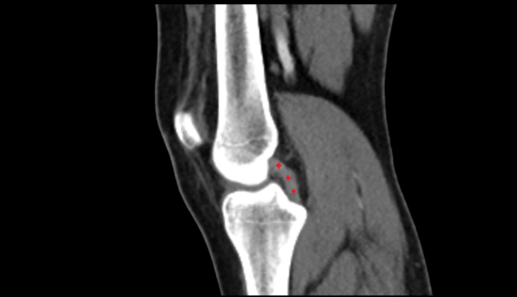 Posterior cruciate ligament (PCL) ct sagittal image
