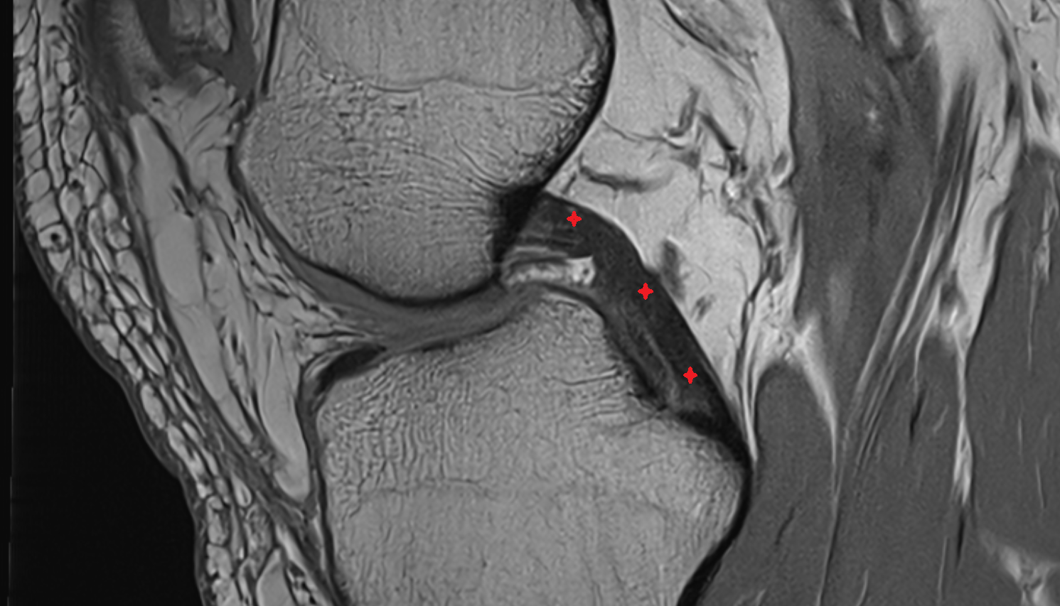 Posterior cruciate ligament (PCL) sagittal cross sectional anatomy 3T MRI AI enhanced  radiology  anatomy image-img-00000-00000