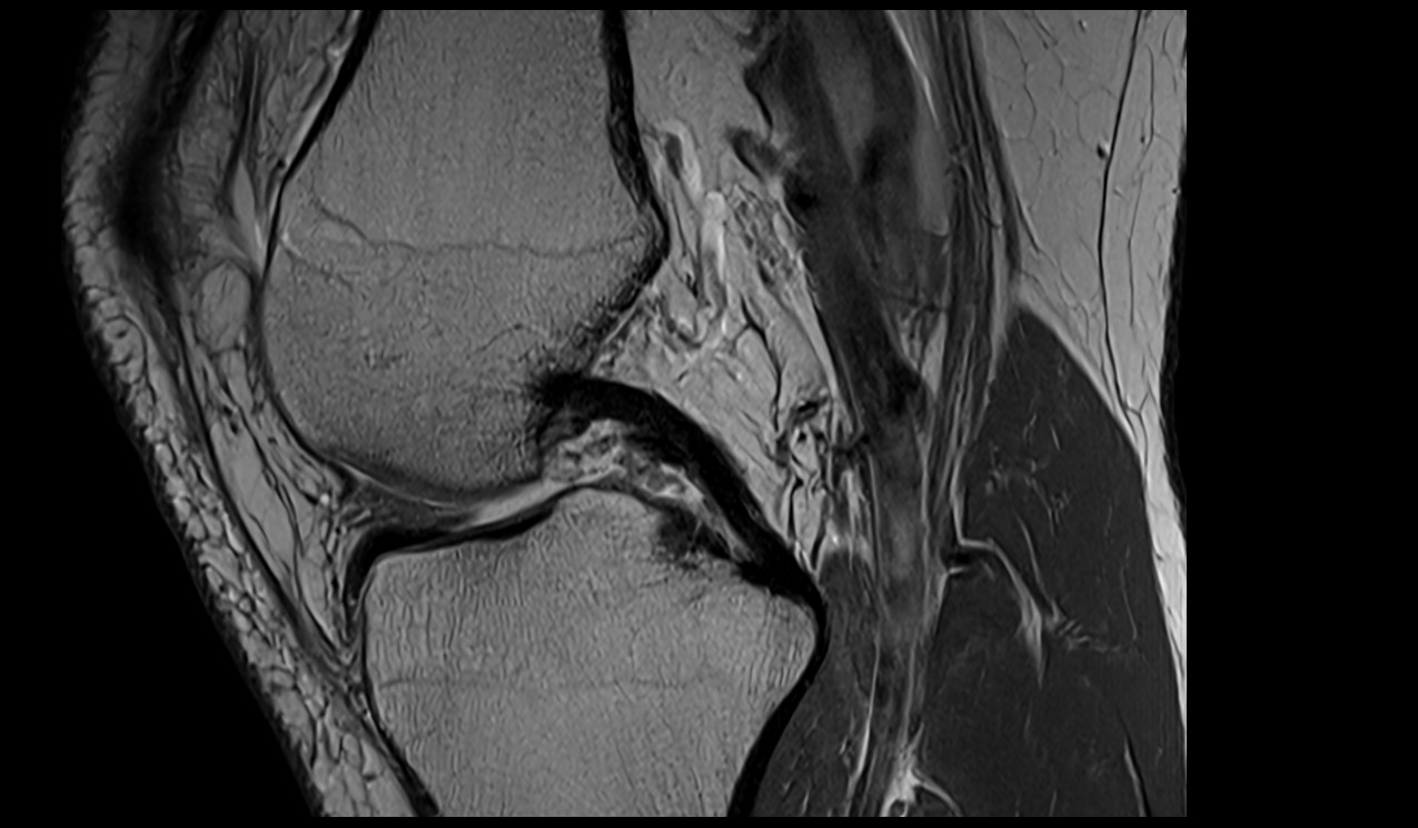 Posterior cruciate ligament anatomy image