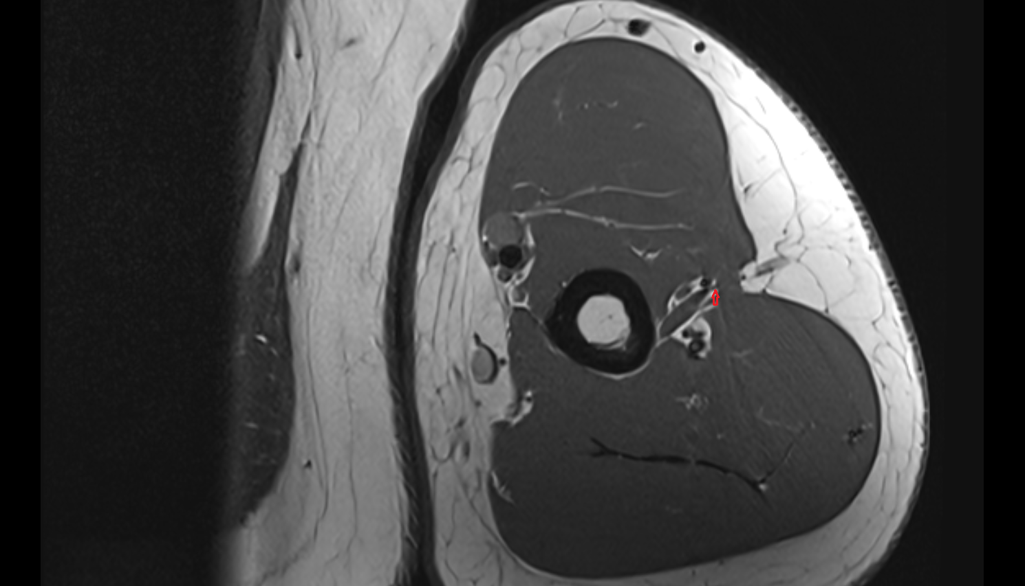 Posterior cutaneous nerve of arm  axial cross sectional anatomy 3T MRI AI enhanced radiology image-img-00000-00000