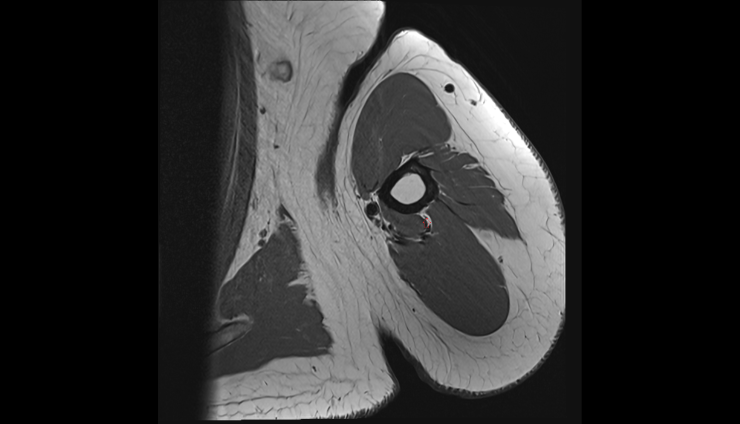 Posterior cutaneous nerve of arm  axial cross sectional anatomy 3T MRI AI enhanced radiology image-img-00000-00000_00000