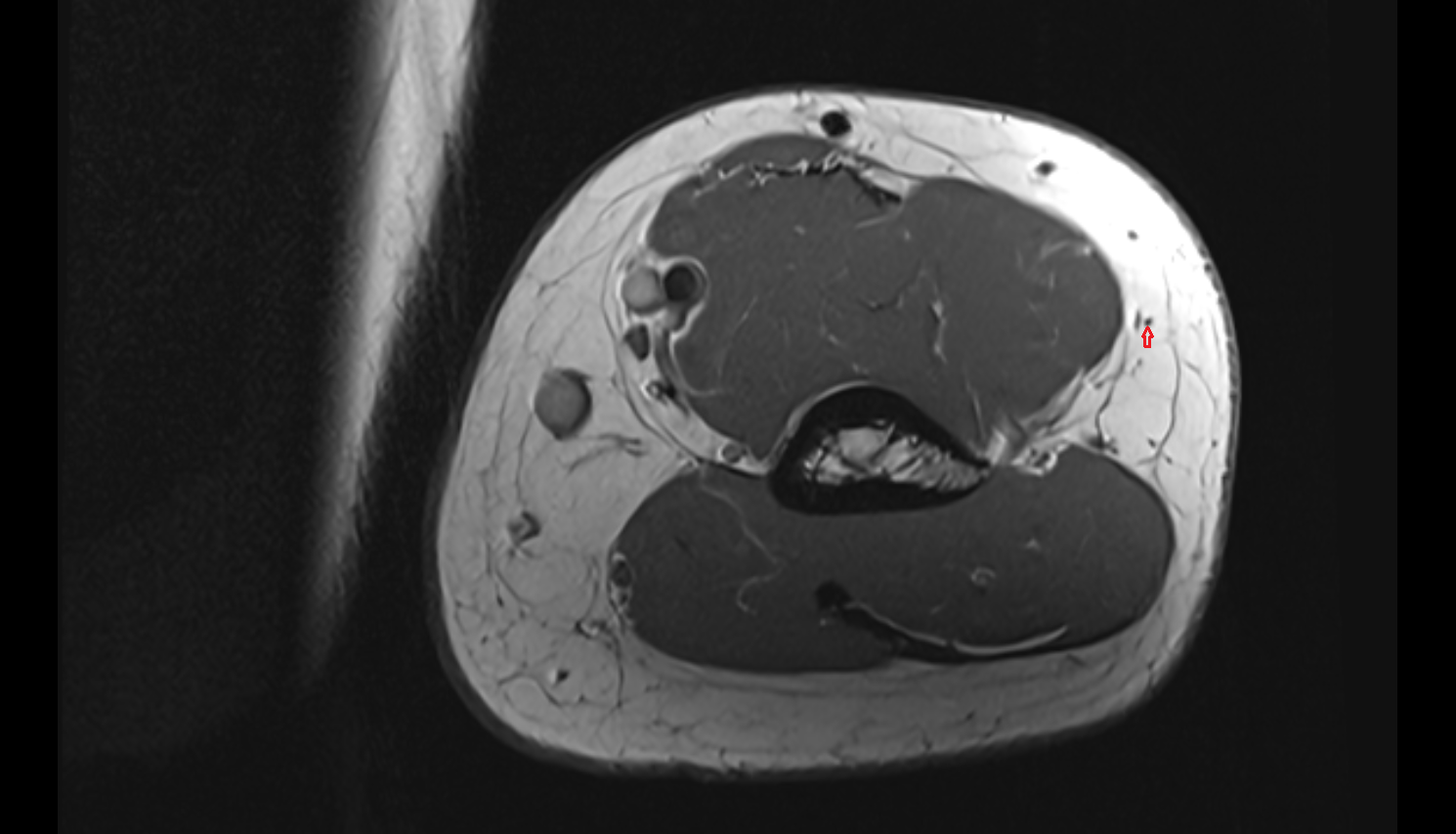 Posterior cutaneous nerve of arm  axial cross sectional anatomy 3T MRI AI enhanced radiology image-img-00000-00000_00002