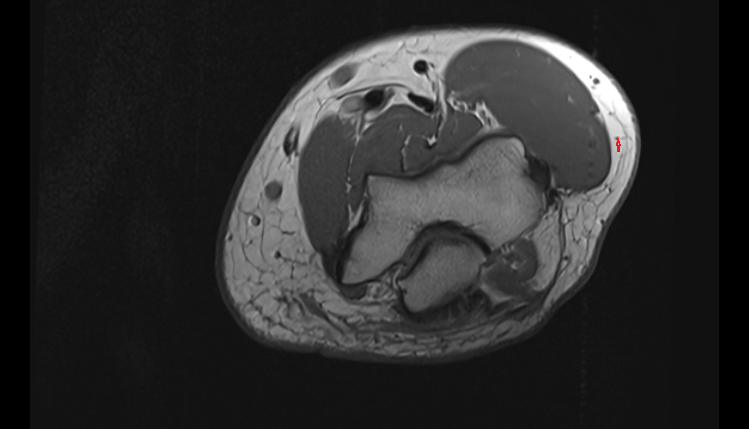 Posterior cutaneous nerve of arm  axial cross sectional anatomy 3T MRI AI enhanced radiology image-img-00000-00000_00003