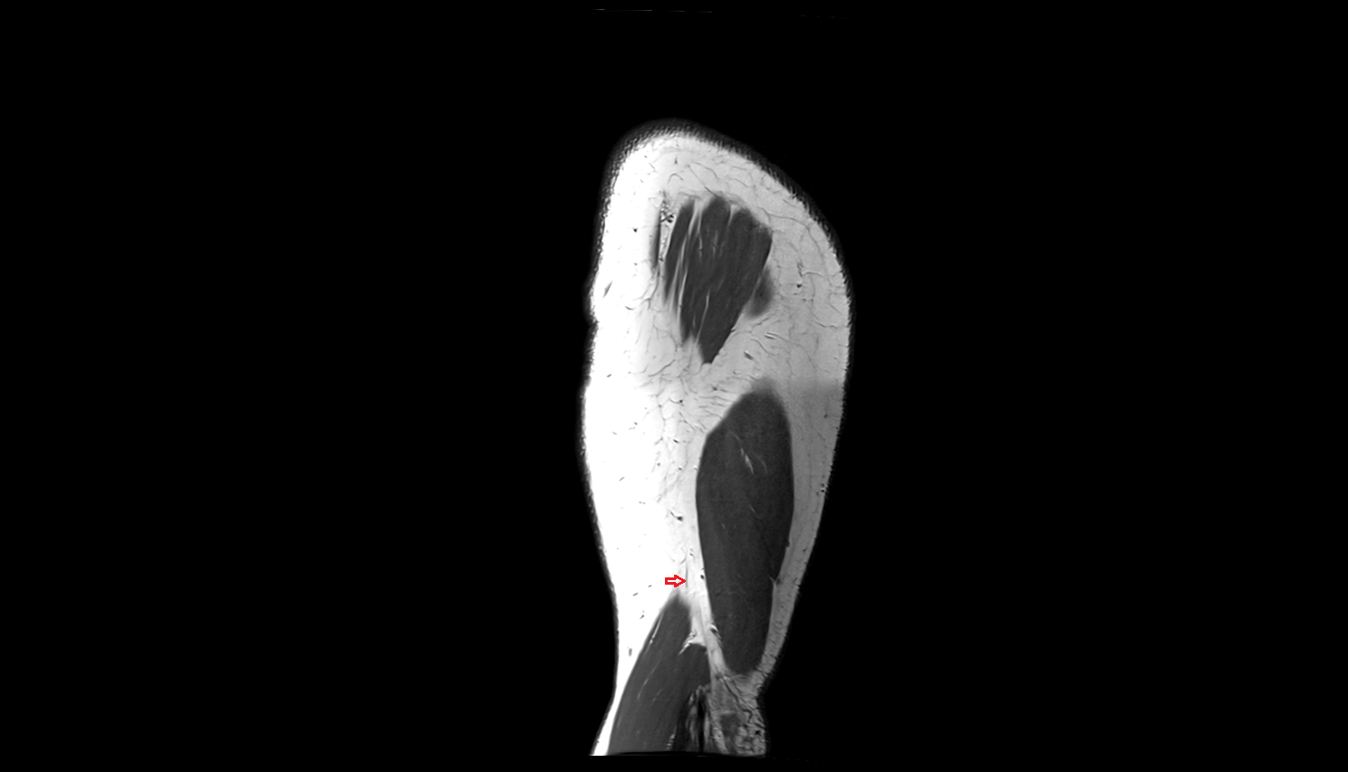Posterior cutaneous nerve of arm  axial cross sectional anatomy 3T MRI AI enhanced radiology image-img-00000-00000_00004