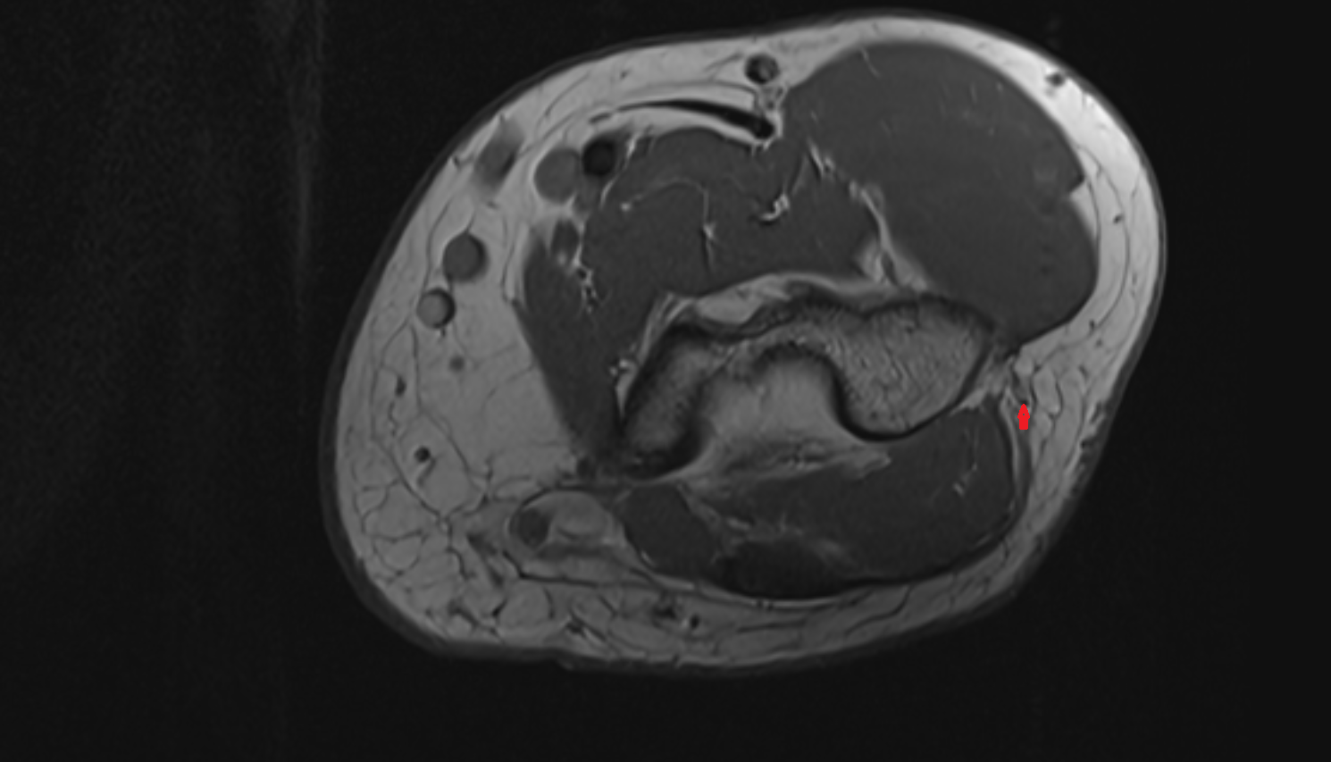 Posterior cutaneous nerve of forearm  axial cross sectional anatomy 3T MRI AI enhanced radiology image -img-00000-00000