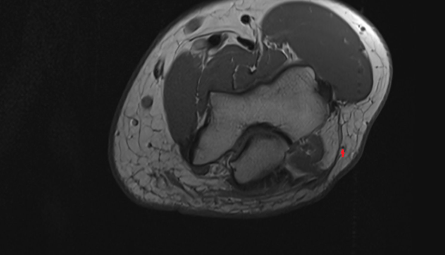 Posterior cutaneous nerve of forearm  axial cross sectional anatomy 3T MRI AI enhanced radiology image -img-00000-00000_00001