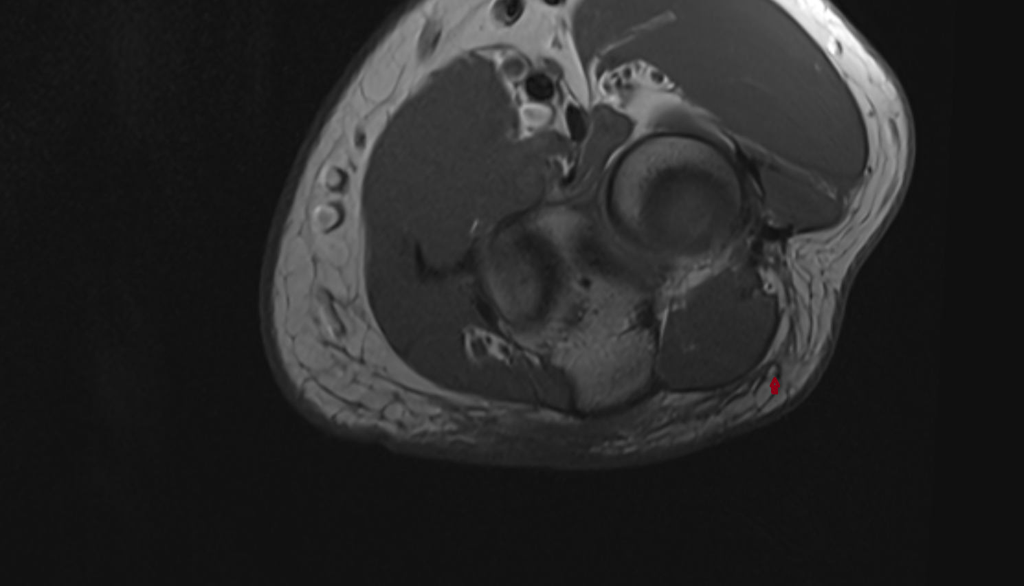 Posterior cutaneous nerve of forearm  axial cross sectional anatomy 3T MRI AI enhanced radiology image -img-00000-00000_00002
